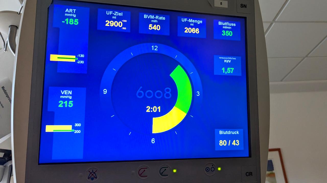 Monitor eines Dialysegerätes mit Ansicht der Einstellungen und Fortschritte der Dialysebehandlung